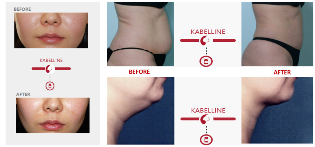 Kabelline Lipolysis Solution (8ml x 5 vials)